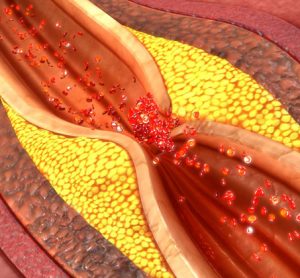 Percutaneous coronary intervention (PCI