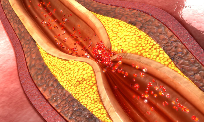 Percutaneous coronary intervention (PCI