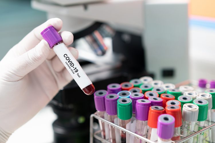 gloved hand holding a blood sample vial labelled 'COVID-19 test' next to a microscope