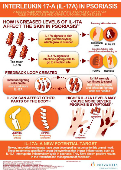 psoriasis