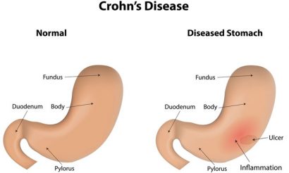 crohns-disease-image