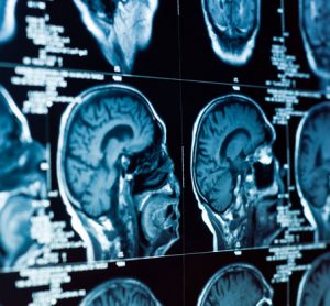 Artificial Intelligence improves stroke and dementia diagnosis in CT brain scan