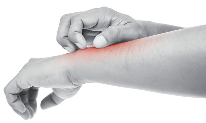 dermatitis inflamed eczema arm