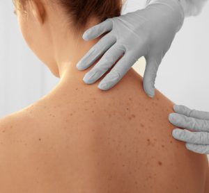 Close up of a Dermatologist examining a patient's back in clinic