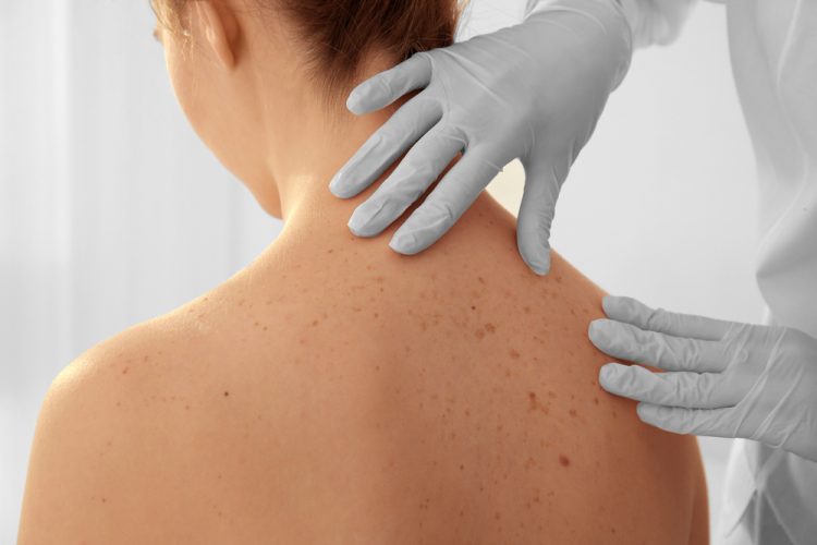 Close up of a Dermatologist examining a patient's back in clinic