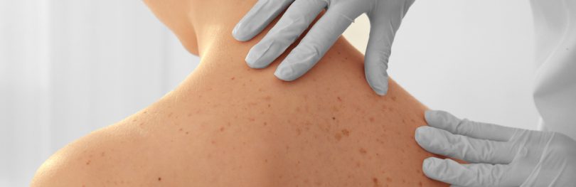 Close up of a Dermatologist examining a patient's back in clinic