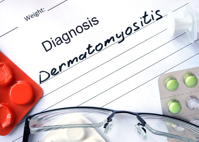 dermatomyositis