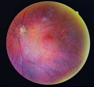 diabetic retinopathy