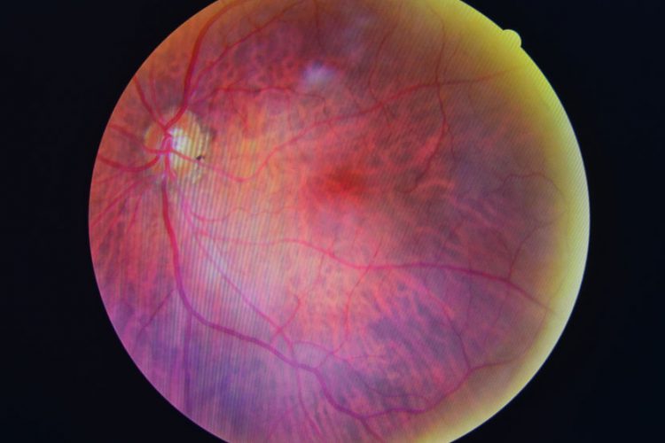 diabetic retinopathy