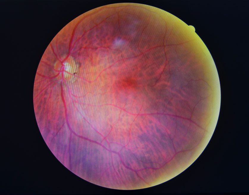 diabetic retinopathy