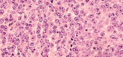 EC approves Zynlonta® for large B-cell lymphoma