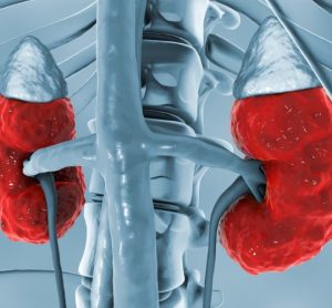 New chronic kidney disease treatment option empagliflozin approved in EU