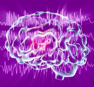 Epilepsy seizure concept - brain overlaid with encephalograph lines of seizure activity