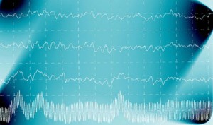 epilepsy-eslicarbazepine