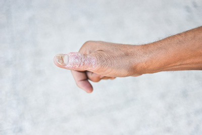 fingernail psoriasis