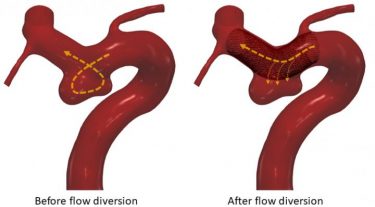 Effect of a flow diverter on blood flow around a brain aneurysm. Once the flow diverter is in place, it reduces blood flow to the aneurysm, allowing it to heal [Credit: University of Leeds].
