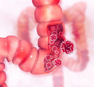 Takeda to license potential treatment for colorectal cancer - fruquintinib