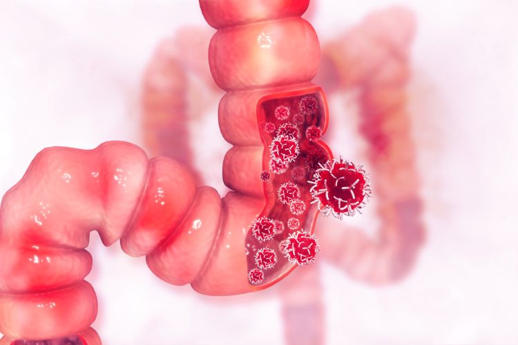 Takeda to license potential treatment for colorectal cancer - fruquintinib