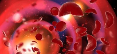 Could novel gene therapy treat sickle cell disease?