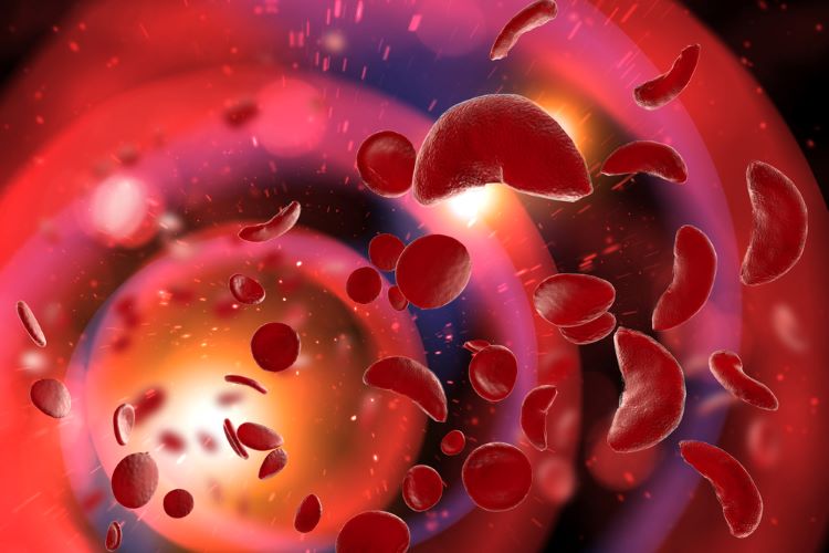 Could novel gene therapy treat sickle cell disease?