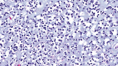 Glioblastoma