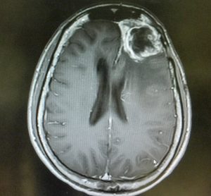 MRI scan of the brain showing a large mass (glioblastoma) behind the right eye of the patient. View is from the top of the skull with the eyes facing up and bakc of head at the bottom of the image
