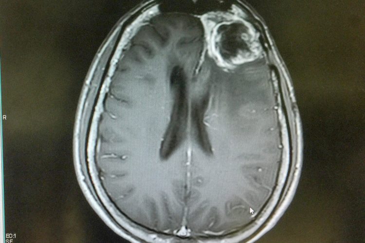 MRI scan of the brain showing a large mass (glioblastoma) behind the right eye of the patient. View is from the top of the skull with the eyes facing up and bakc of head at the bottom of the image