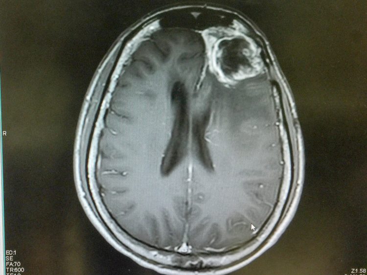 MRI scan of the brain showing a large mass (glioblastoma) behind the right eye of the patient. View is from the top of the skull with the eyes facing up and bakc of head at the bottom of the image