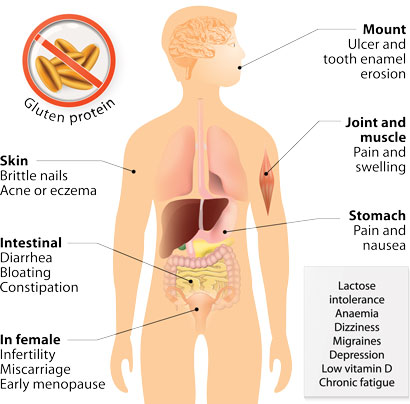 gluten-free-coeliac-disease