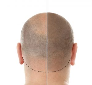 hair loss