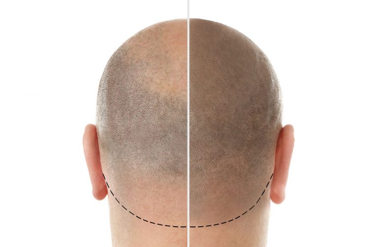 hair loss