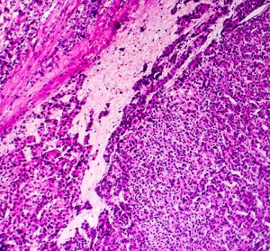 light micrograph of hepatocellular carcinoma