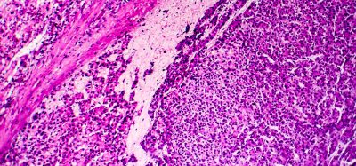 light micrograph of hepatocellular carcinoma