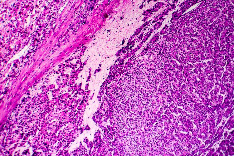 light micrograph of hepatocellular carcinoma