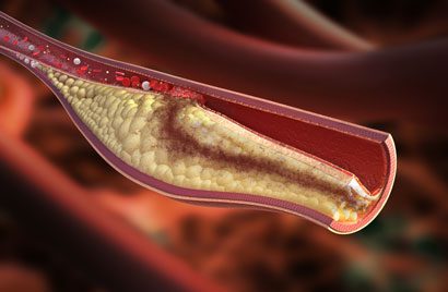 high-cholesterol