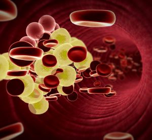 3D illustration of red blood cells and yellow triglyceride/fat globules in a blood vessel - idea of hypercholesterolaemia or hypertriglyceridemia