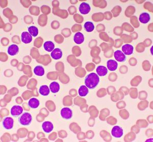 NICE recommends therapy duo for advanced leukaemia - ibrutinib plus venetoclax