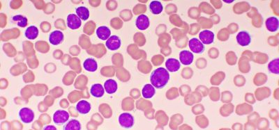 NICE recommends therapy duo for advanced leukaemia - ibrutinib plus venetoclax