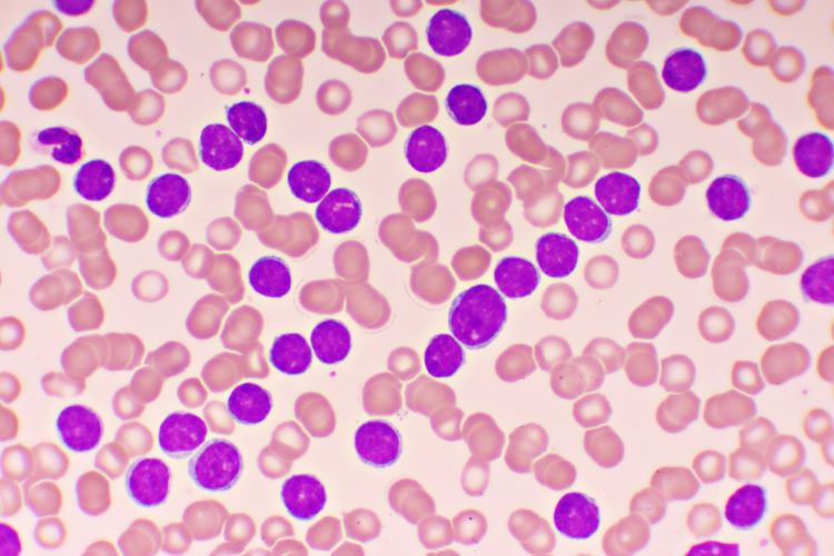 NICE recommends therapy duo for advanced leukaemia - ibrutinib plus venetoclax