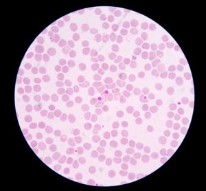 immune thrombocytopenia