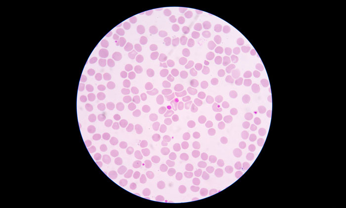 immune thrombocytopenia