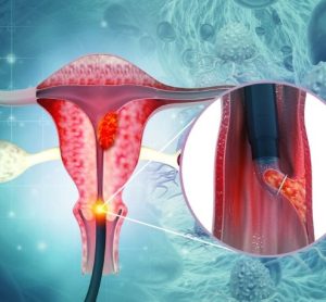 First immunotherapy recommended for advanced cervical cancer - final guidance