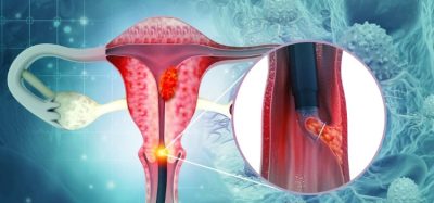First immunotherapy recommended for advanced cervical cancer - final guidance