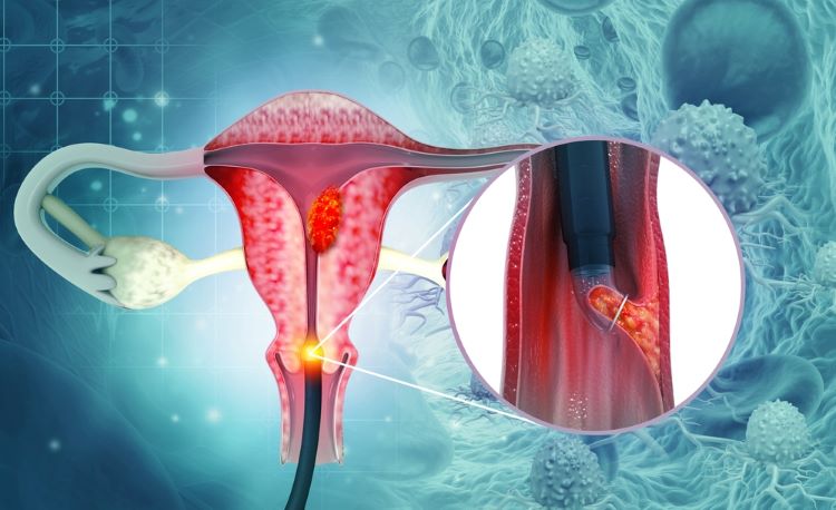 First immunotherapy recommended for advanced cervical cancer - final guidance