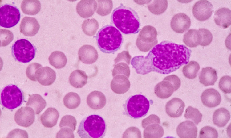 leukaemia