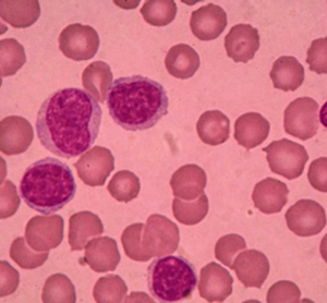 Leukaemia