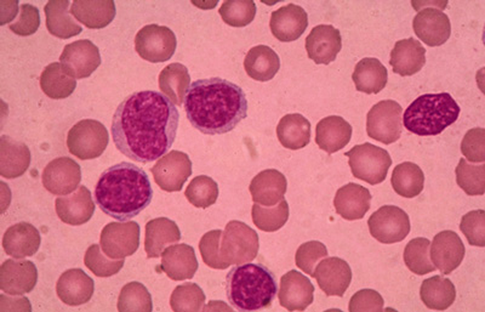 Leukaemia