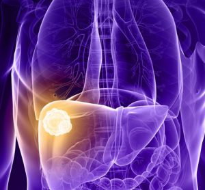 liver-cancer-RS-treatment