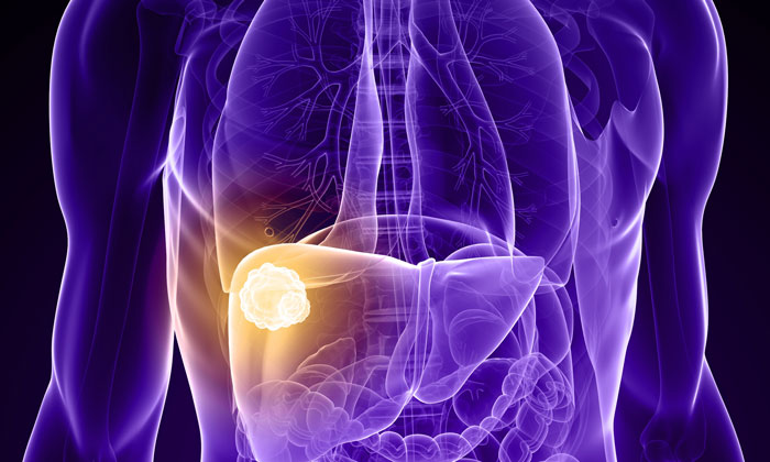 liver-cancer-RS-treatment