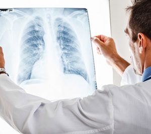 lung cancer